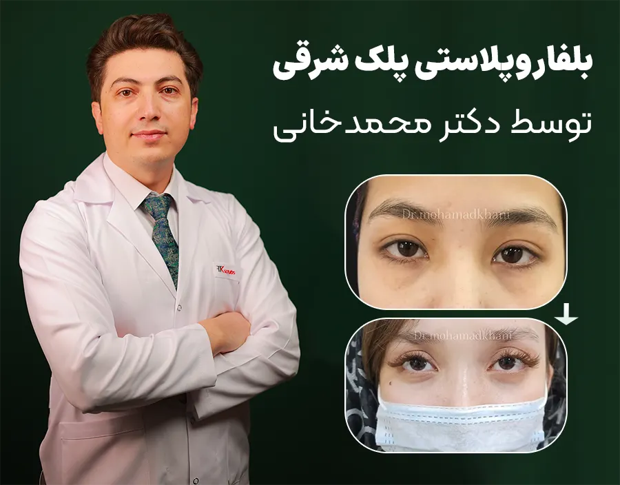 بلفاروپلاستی پلک شرقی توسط دکتر محمدخانی