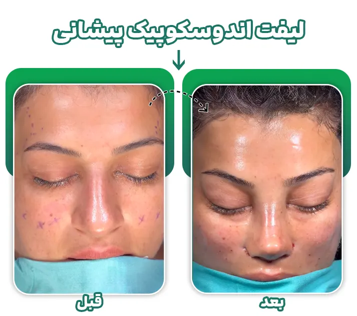 لیفت اندوسکوپیک پیشانی
