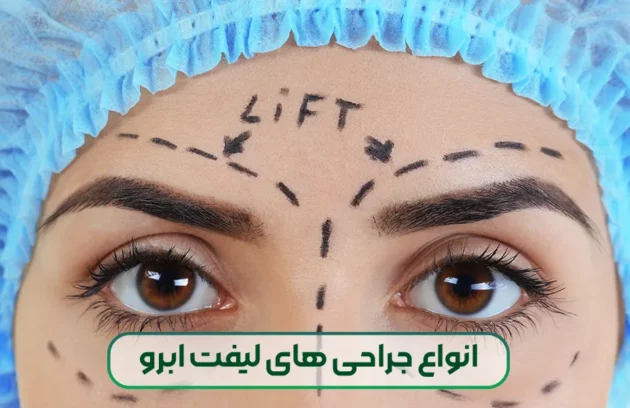 انواع جراحی های لیفت ابرو