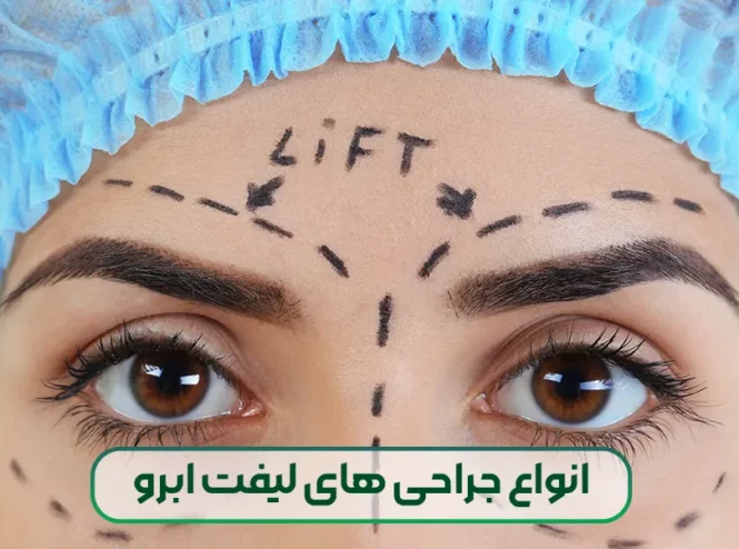 انواع جراحی های لیفت ابرو