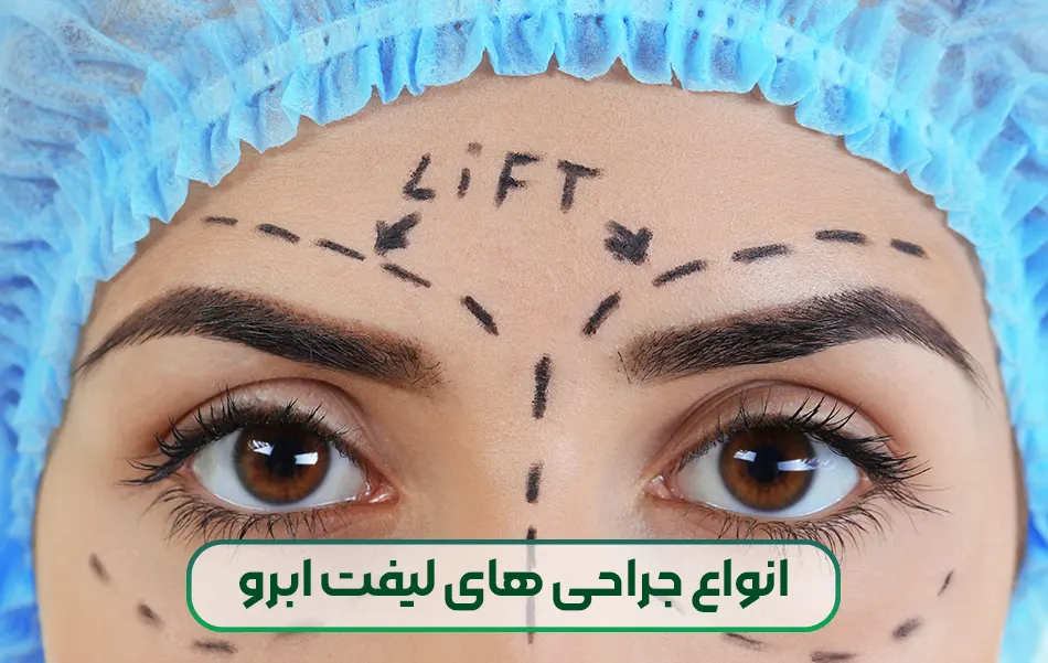 انواع جراحی های لیفت ابرو