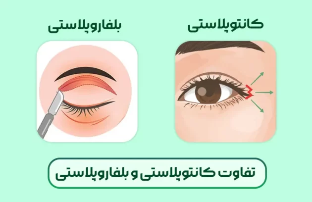 تفاوت کانتوپلاستی و بلفاروپلاستی