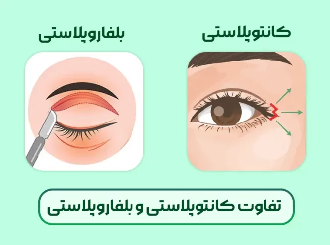 تفاوت کانتوپلاستی و بلفاروپلاستی
