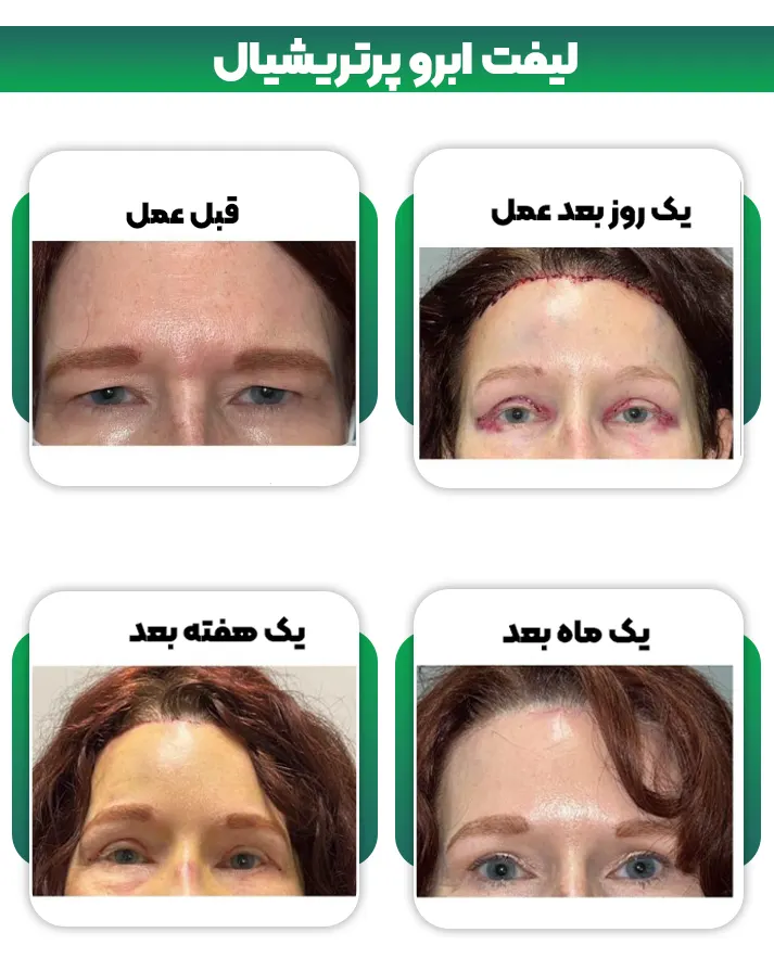 لیفت ابرو پرتریشیال