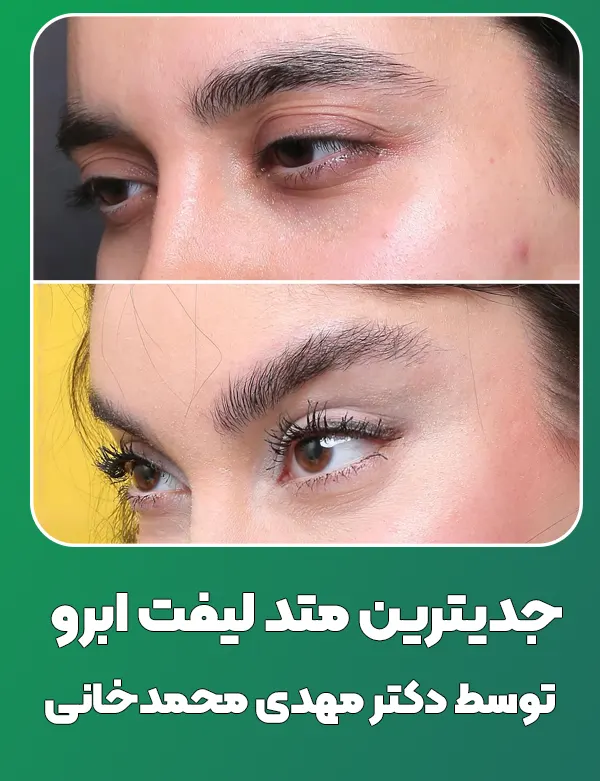 لیفت ابرو توسط دکتر محمدخانی