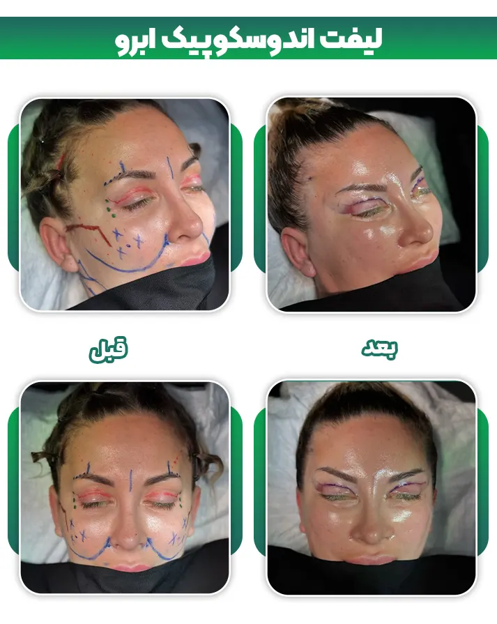 لیفت اندوسکوپیک ابرو