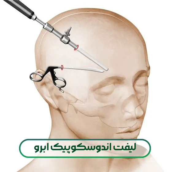 لیفت اندوسکوپیک ابرو