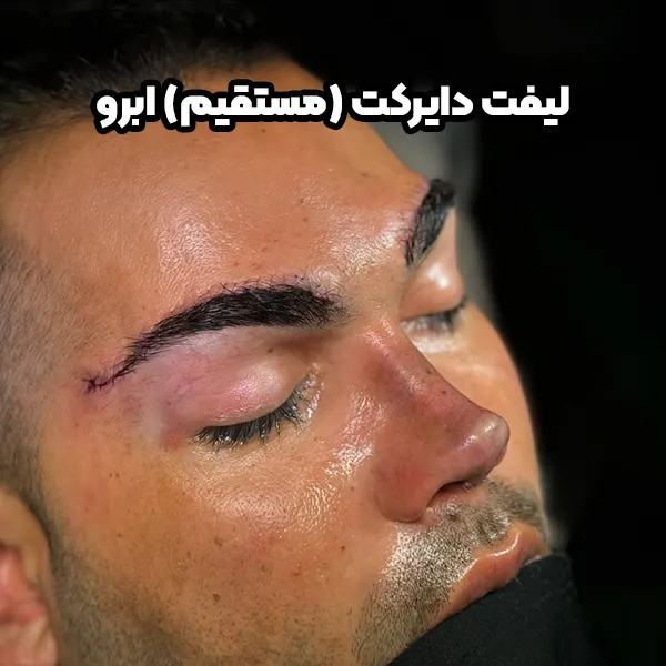 لیفت دایرکت ابرو