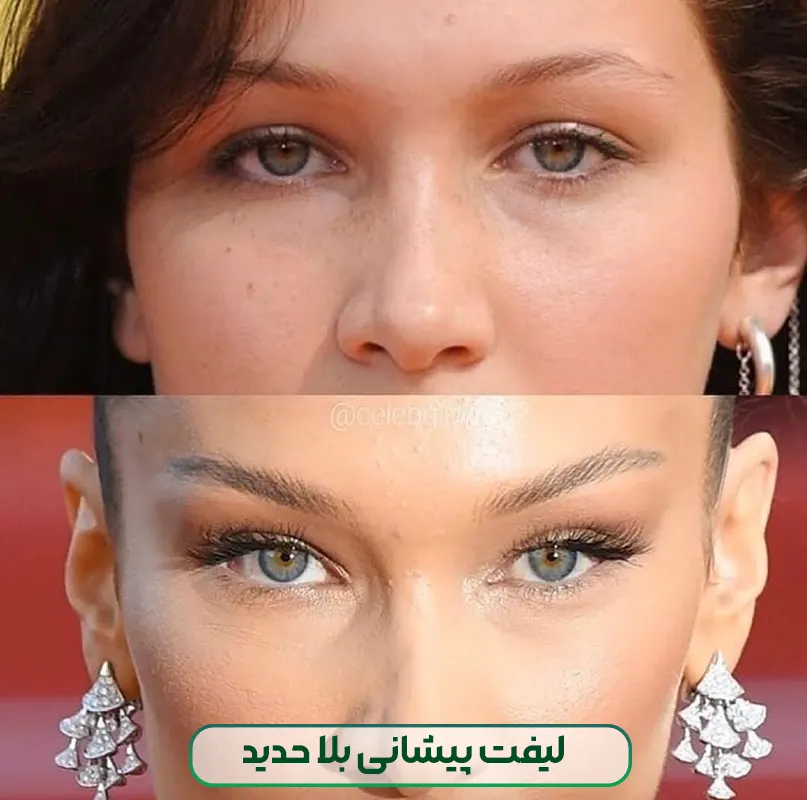 لیفت پبشانی بلا حدید