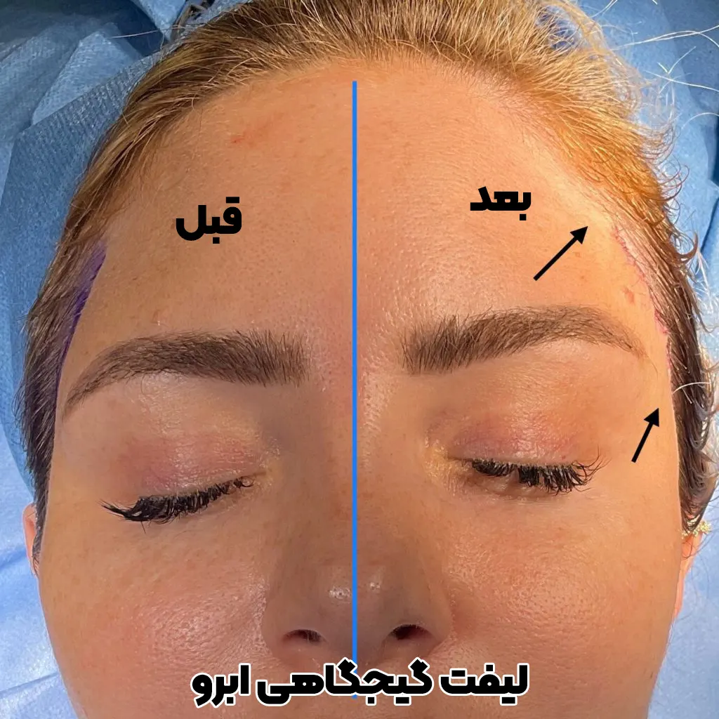 لیفت گیجگاهی ابرو