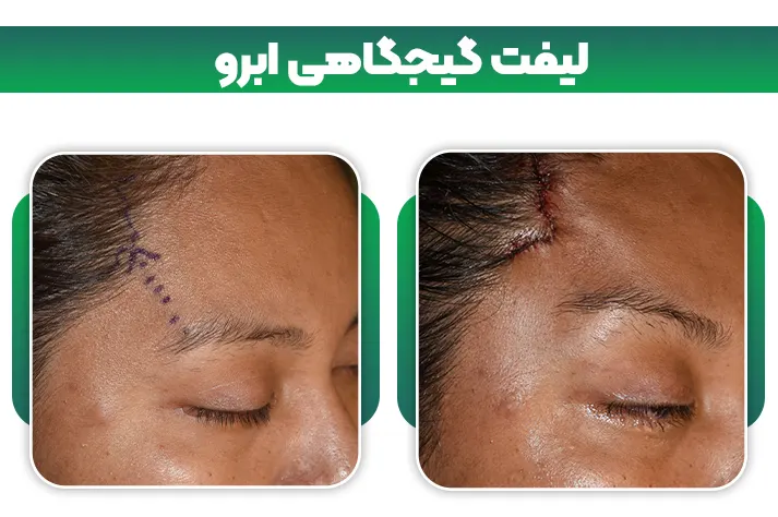 لیفت گیجگاهی ابرو