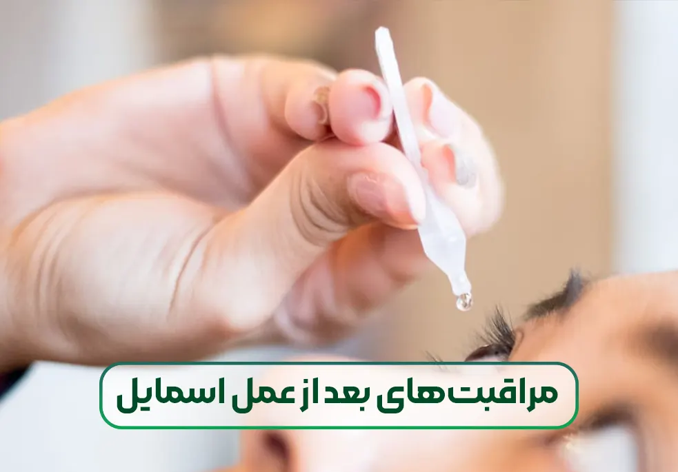 مراقبتهای مهم بعد از عمل فمتو اسمایل