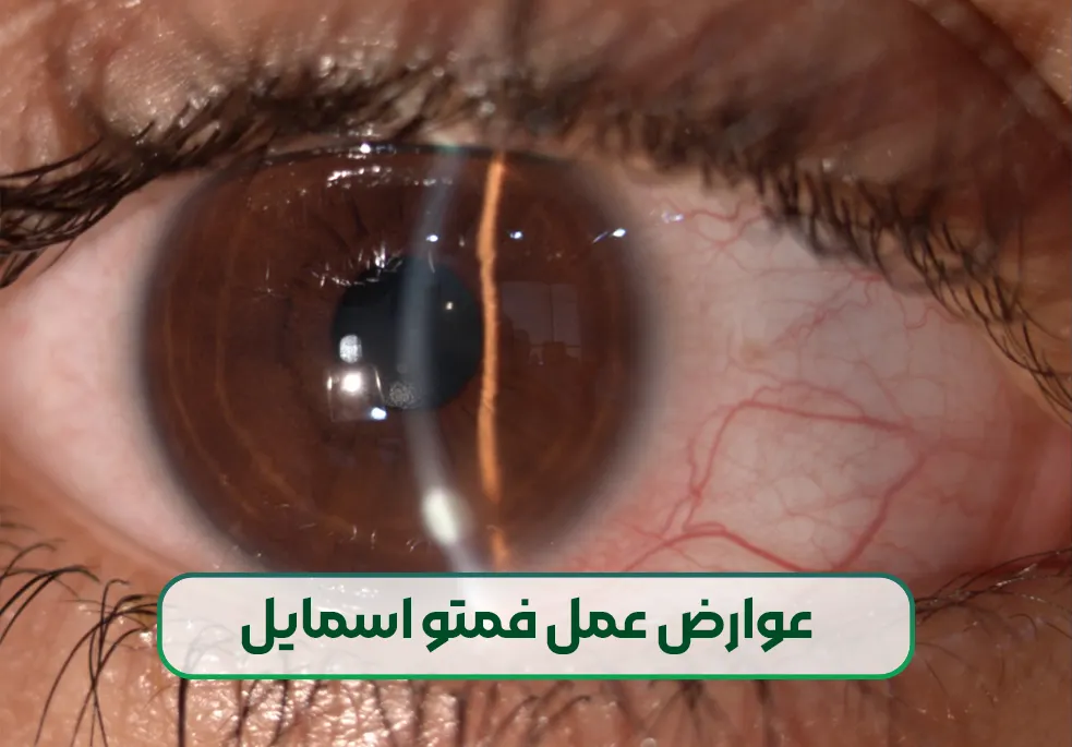 عوارض عمل فمتو اسمایل