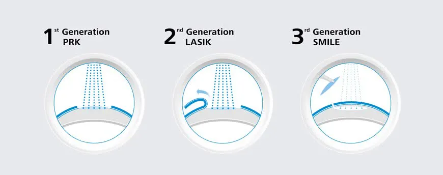 مقایسه اسمایل با لیزیک، لازک و PRK