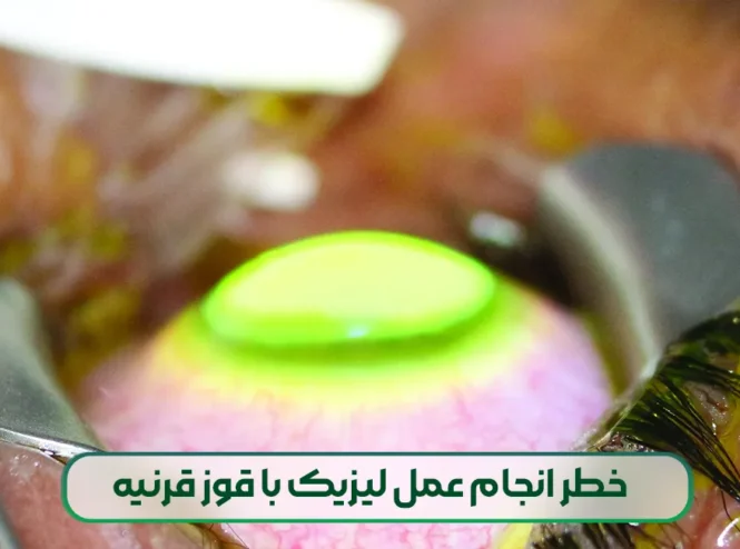 عمل لیزیک با قوز قرنیه