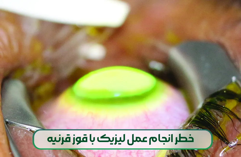 عمل لیزیک با قوز قرنیه