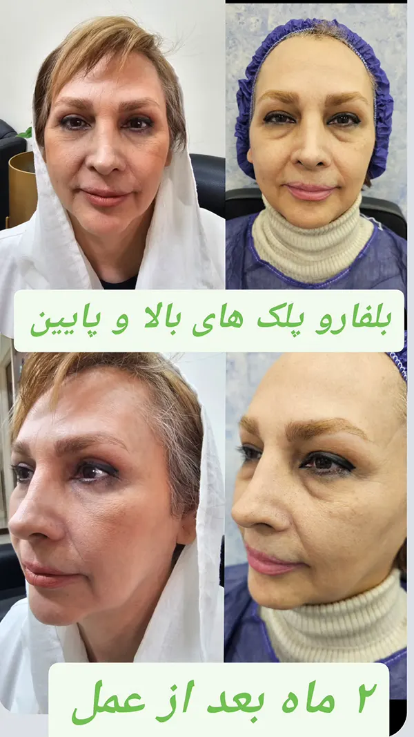 بلفارو پلک پایین و بالا