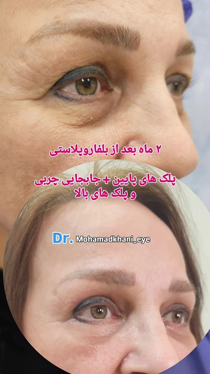 بلفارو پلک پایین