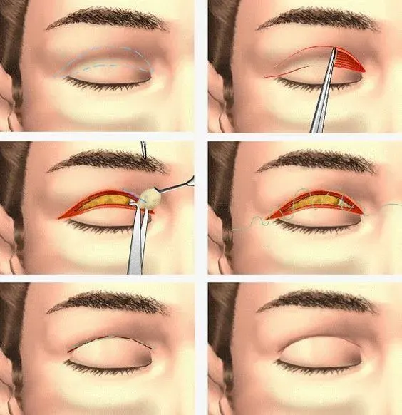 عمل بلفاروپلاستی