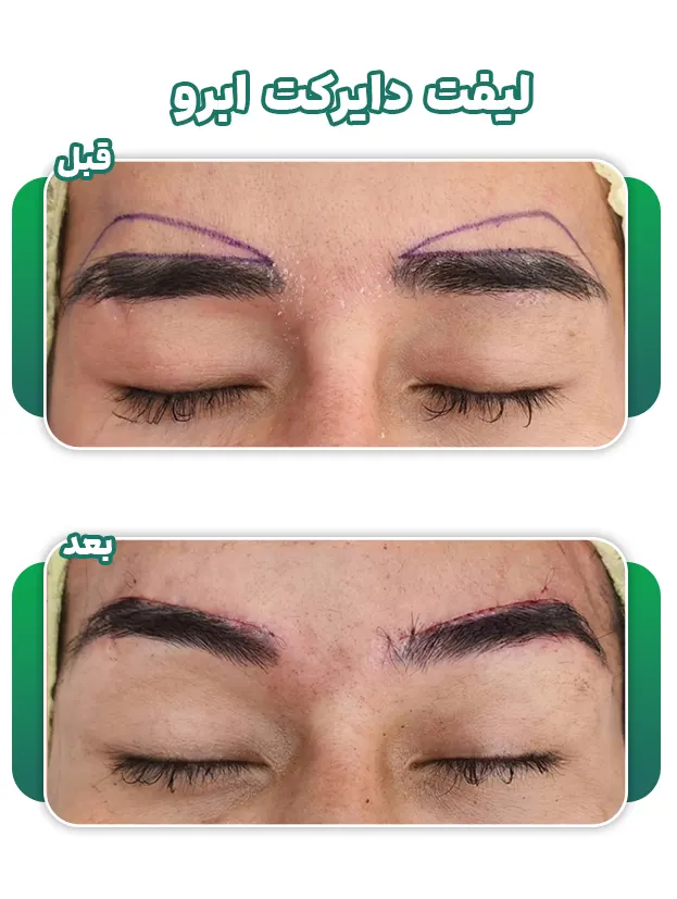 جراحی لیفت دایرکت ابرو