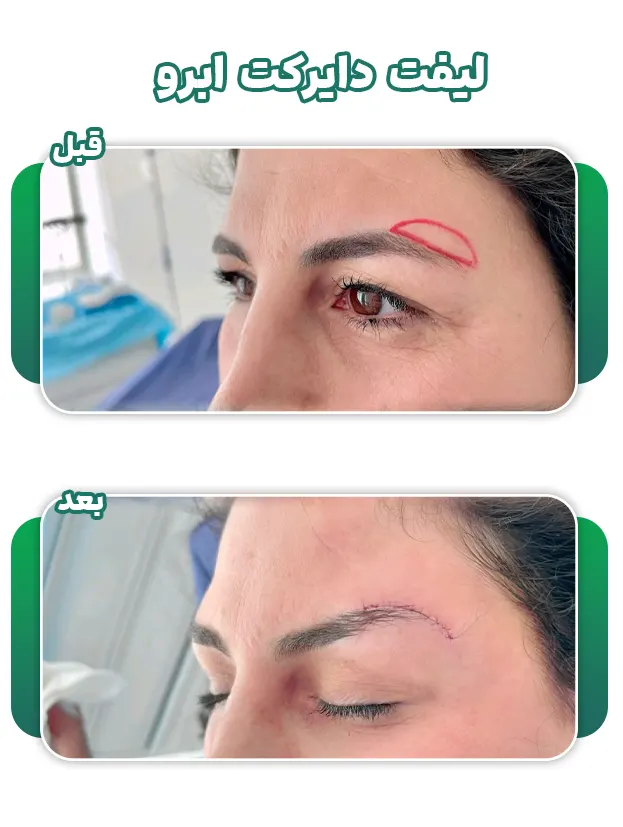 جراحی لیفت دایرکت ابرو