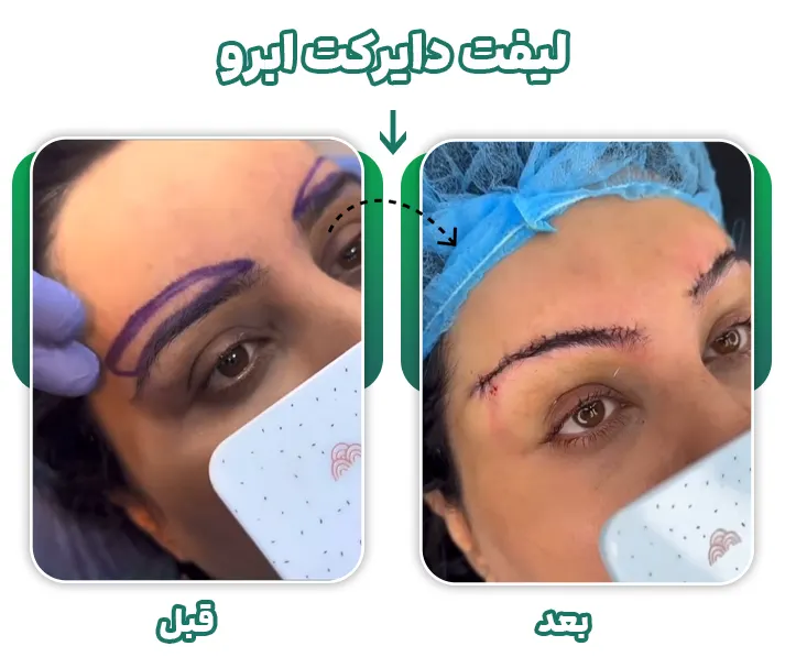 جراحی لیفت دایرکت ابرو