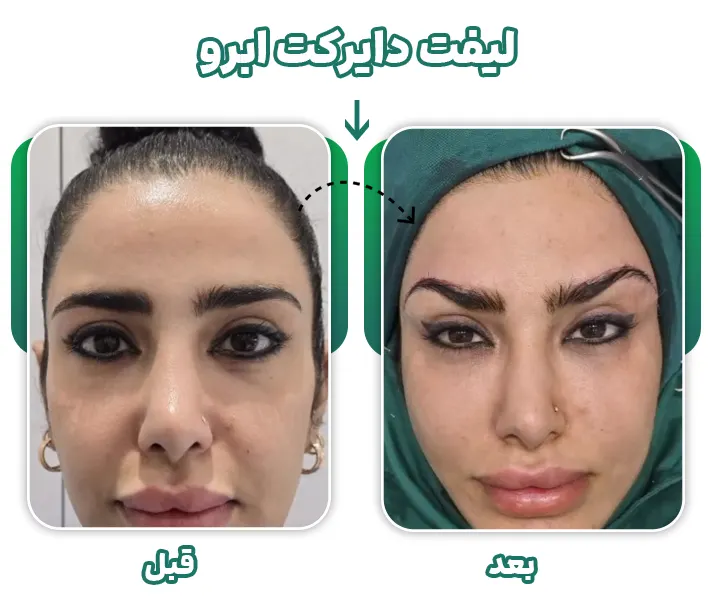 جراحی لیفت دایرکت ابرو