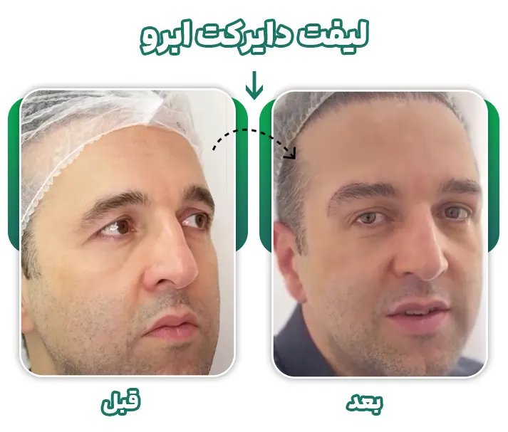 جراحی لیفت دایرکت ابرو