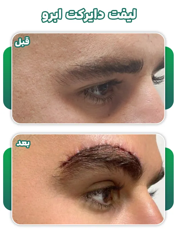 جراحی لیفت دایرکت ابرو
