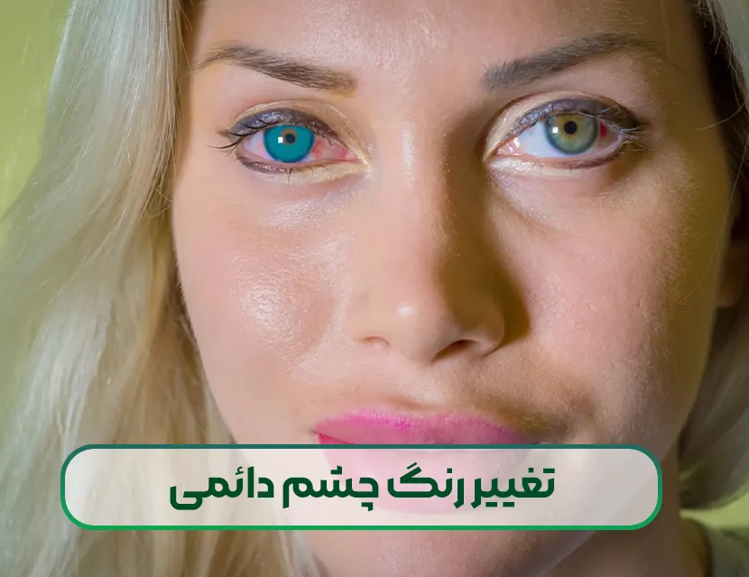 تغییر رنگ چشم