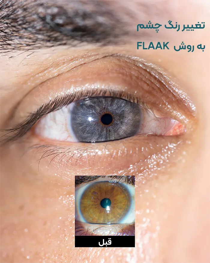 تغییر رنگ چشم با لیزر