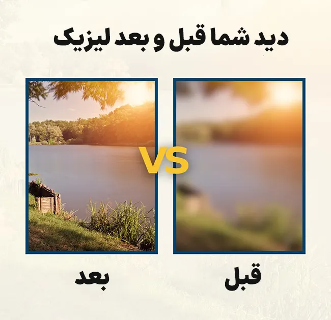 قبل و بعد لیزیک