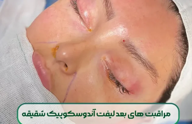 مراقبت های بعد لیفت آندوسکوپیک شقیقه