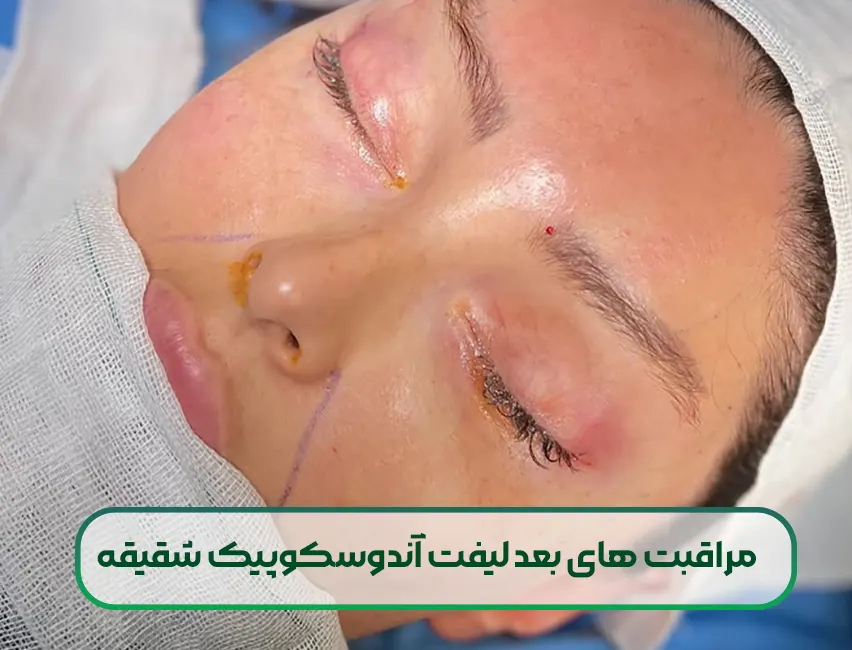 مراقبت های بعد لیفت آندوسکوپیک شقیقه