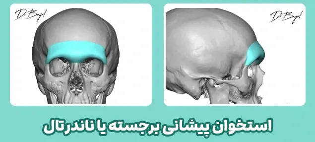 استخوان پیشانی برجسته یا ناندرتال
