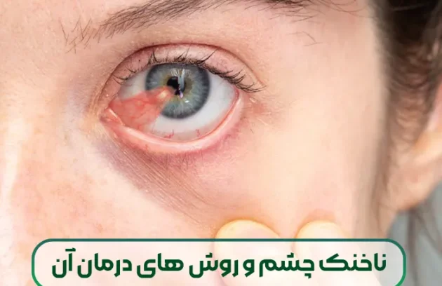 ناخنک چشم