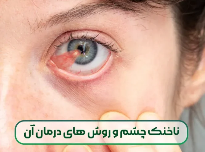 ناخنک چشم