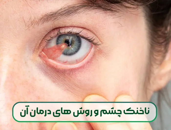 ناخنک چشم