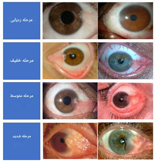 انواع درجه ناخنک چشم