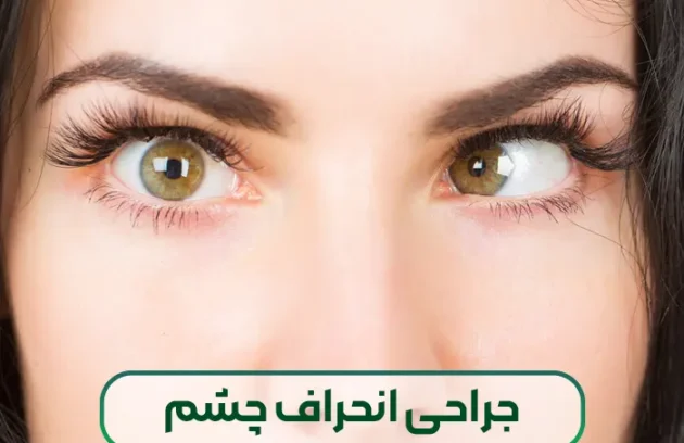 جراحی انحراف چشم