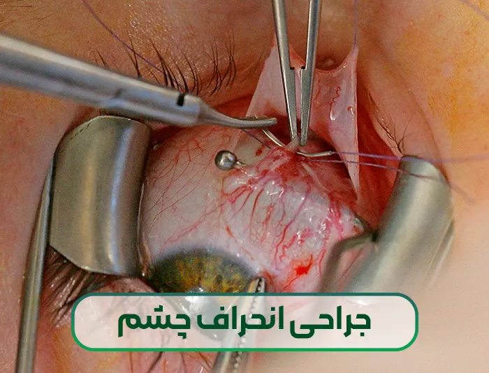 جراحی انحراف چشم