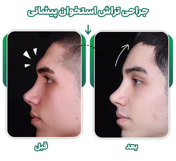 جراحی تراش استخوان پیشانی برجسته