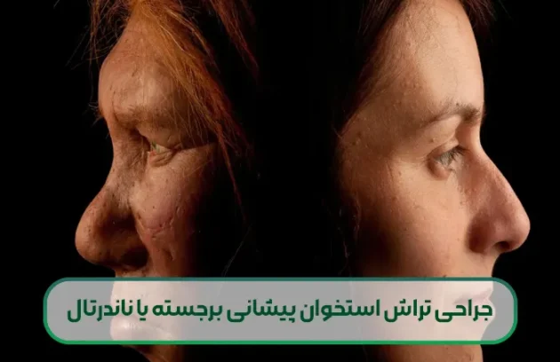 جراحی تراش استخوان پیشانی برجسته یا ناندرتال