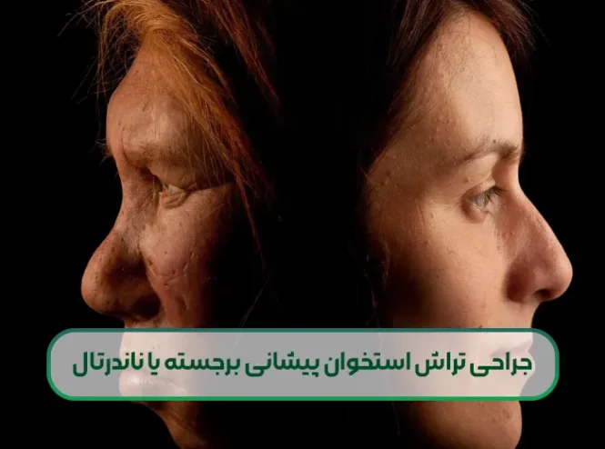 جراحی تراش استخوان پیشانی برجسته یا ناندرتال