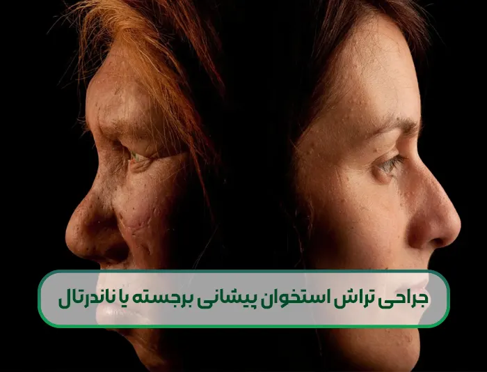 جراحی تراش استخوان پیشانی برجسته یا ناندرتال