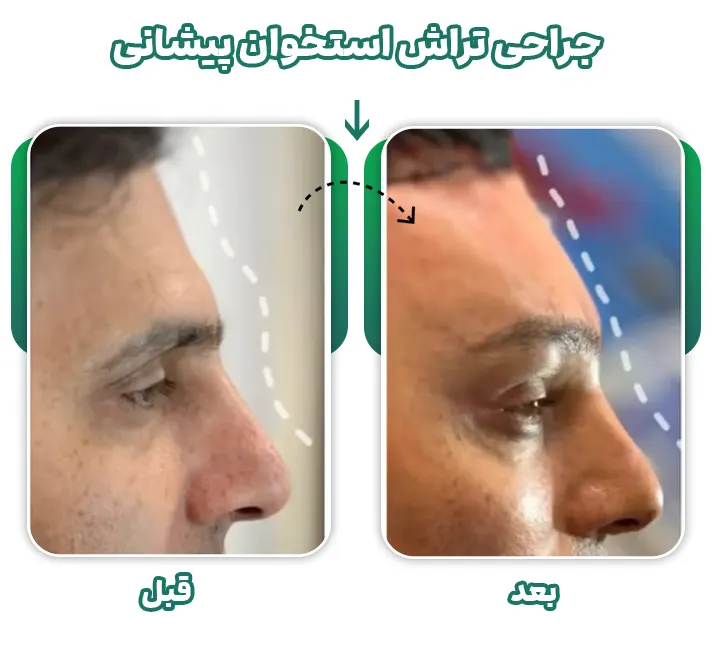 جراحی استخوان پیشانی نئاندرتالی