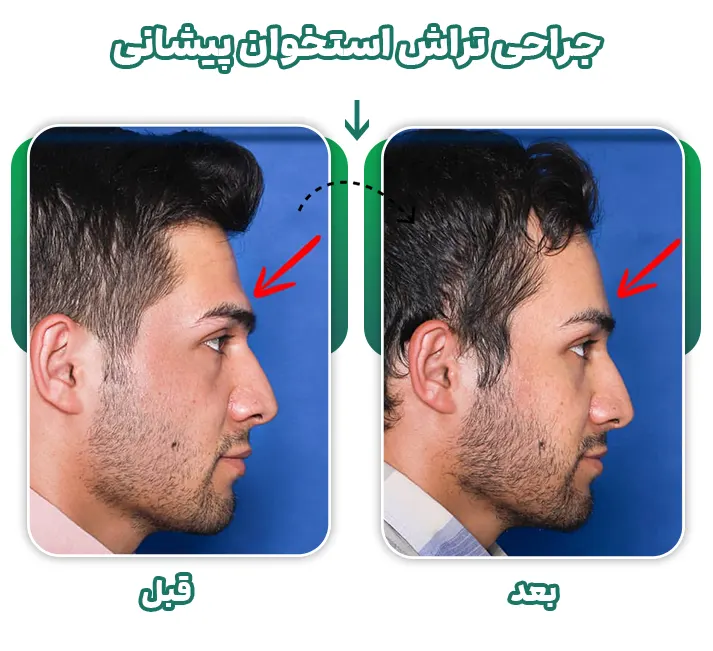 جراحی استخوان پیشانی ناندرتالی