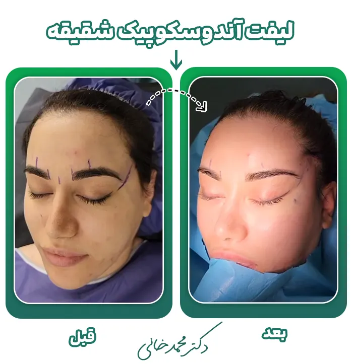 لیفت آندوسکوپیک شقیقه