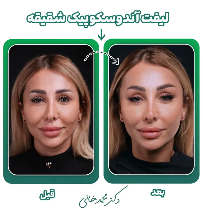 لیفت آندوسکوپیک شقیقه