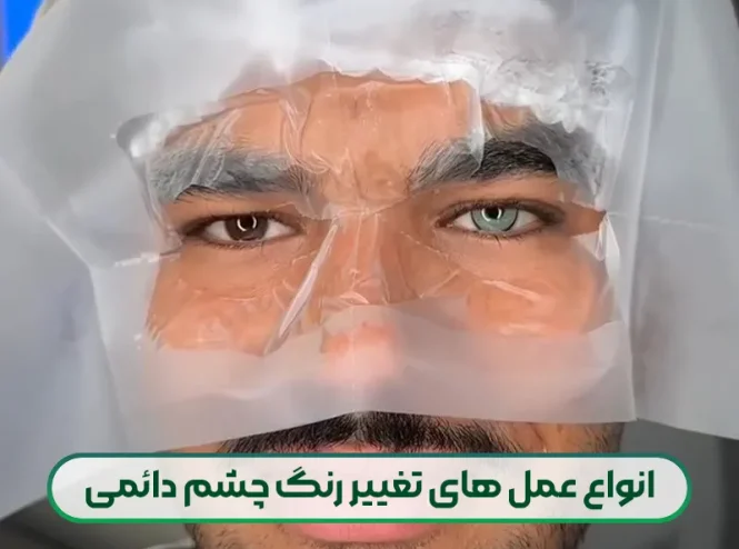 عمل تغییر رنگ چشم + معرفی 3 روش